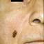 7. Меланома на лице фото