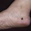 9. Меланома на ноге фото